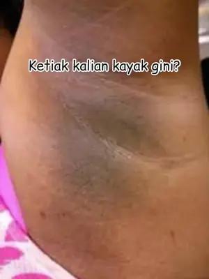 Cream for Dark Underarms Promo